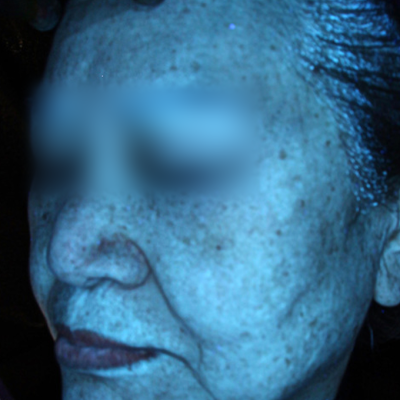 치료사례 썸네일 애프터.png